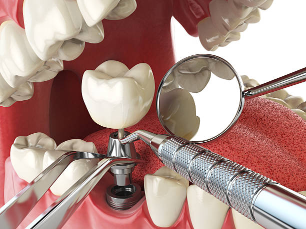 Best Emergency Tooth Extraction in Tulia, TX